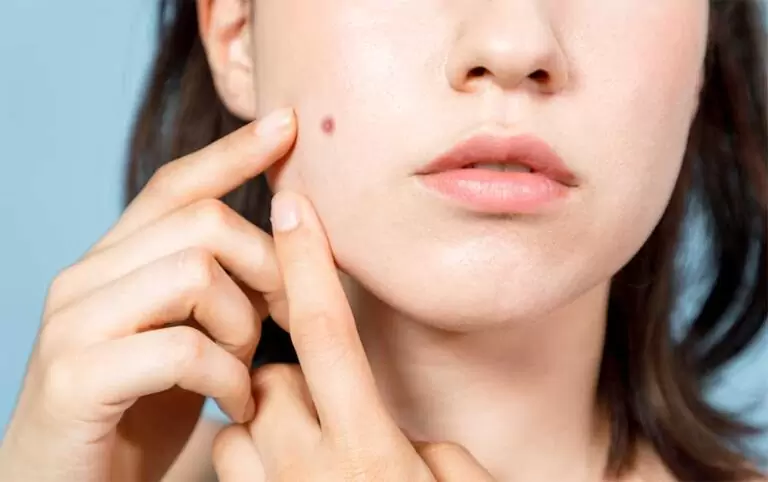 Bilmediği kozmetik ve doğal ürün adı altındaki maddeyi yüzüne süren genç kadın hayatının şokunu yaşadı